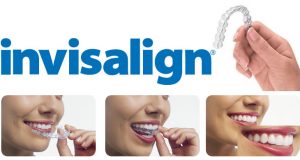 variation-invisalign000